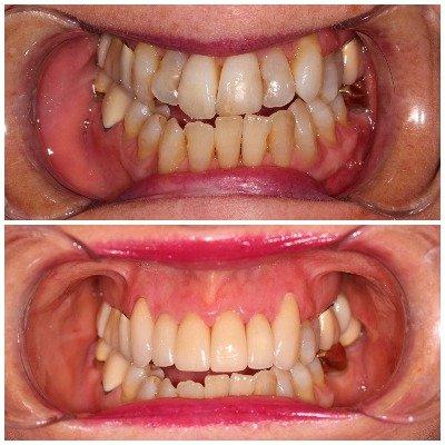 Don't be afraid to smile! Before/after anterior crowns.