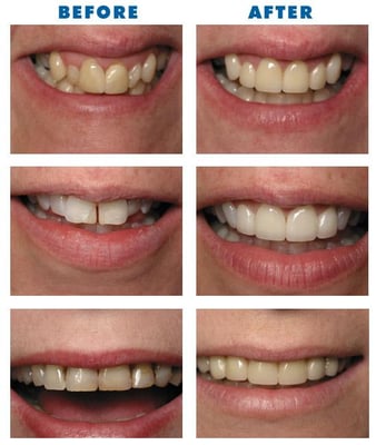 Brooklyn Dental Veneers