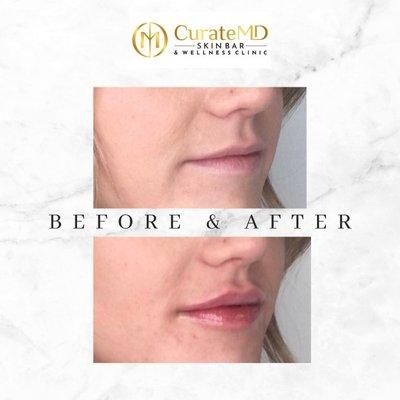 Before and after lip filler