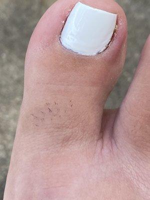 Infected toe nail