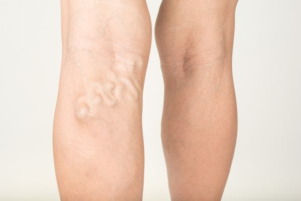 Varicose veins symptoms