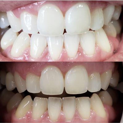 Bottom: before whitening treatment. Top: after whitening treatment.