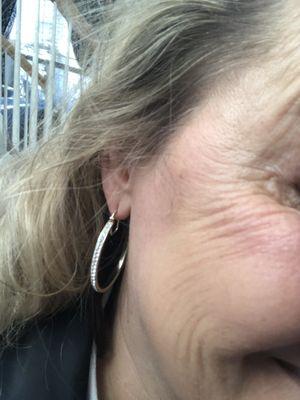 Crows feet after 15 days after receiving "fake Botox" for lords and ladies