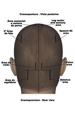 Scalp acupuncture is effective for many issues too such as neurological disorders including post concussive syndrome, parkinsons and much.