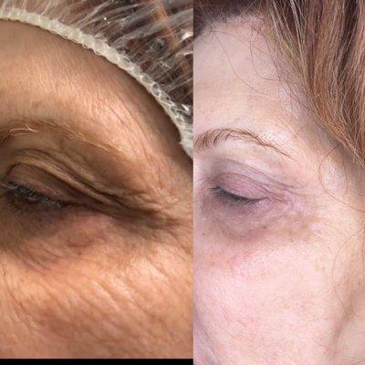 Epidermic Fibroblasty fir skin tightening