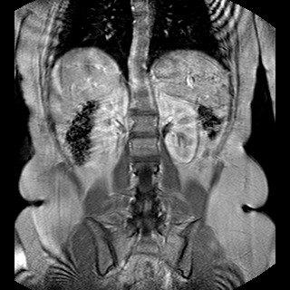 mri of the abdomen