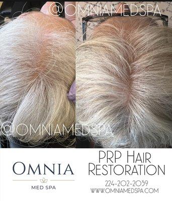 PRP Hair Restoration