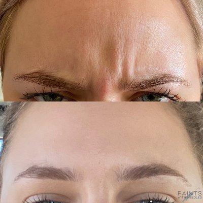 Botox for glabellar lines or "eleven" lines.