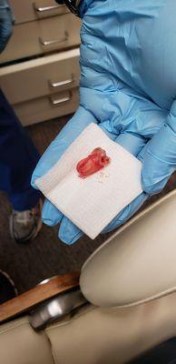 My Wisdom tooth on gauze.