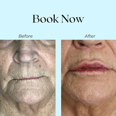 Lip lift & lip filler