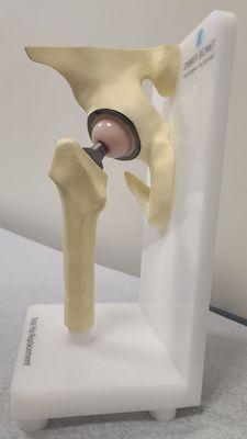 Total Hip Replacement Model  04-29-2024