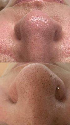 Nose Extractions Before and After.