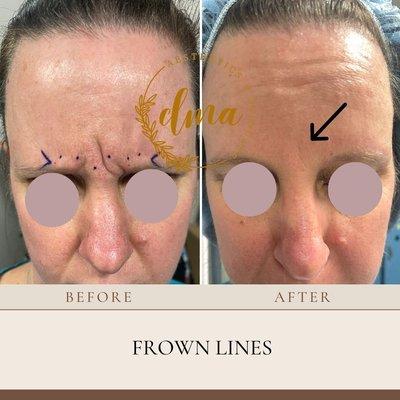 Frown Line Treatments