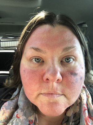 Immediately after IPL at Columbia Skin Clinic