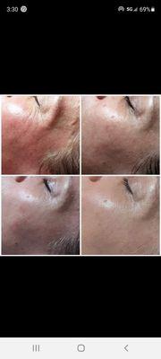 After three sessions amazing results can be appreciated in the skin.