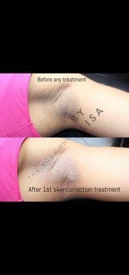 Underarm Skin Color Correction