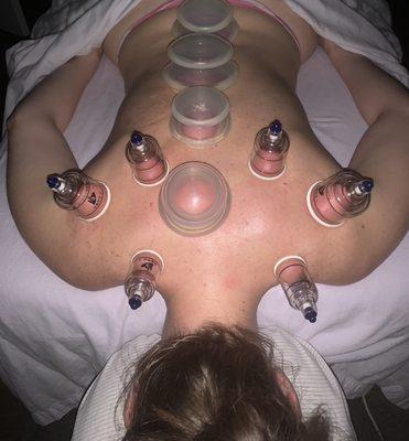 Treating overuse and repetitive motion with both silicone and plastic cupping therapy