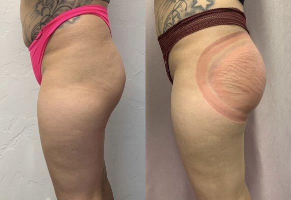 Non invasive BBL (Brazilian Butt lift)