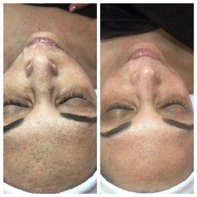 Microdermabrasion Anti Aging Treatment