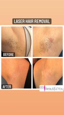 Laser hair removal