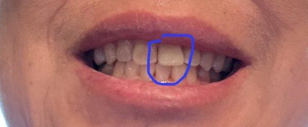 Dr. Oh gave my front Incisor a new look as it was chipped due to accident.