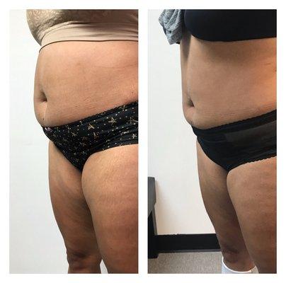 Emsculpt Results!