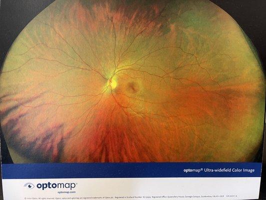 We offer Retinal Imaging  Optomap to check for Diabetic Retinopathy, Glaucoma, Retina detachments and Various other eye disease