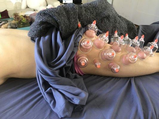 Dry Cupping-Treating a leg injury.