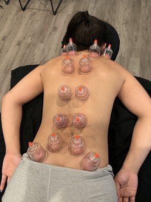 Cupping therapy to erector spinae