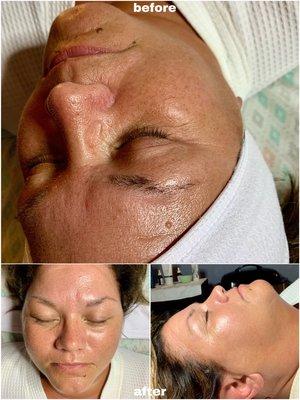 Before and after of a dermaplane facial