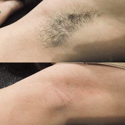 Before and after armpit sugar wax