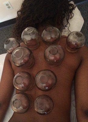 A happy patient receiving cupping for muscle tension.