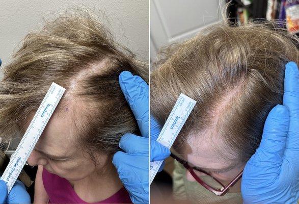 Our women's hair regrowth team has over 15 years of regenerative experience in PBC hair restoration...