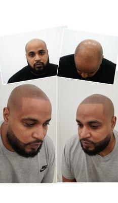 Artisan Scalp Micropigmentation