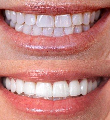 Veneers!!