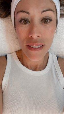 After hydra facial treatment