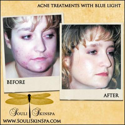 light therapy for acne