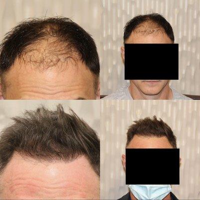 Patient underwent an FUE procedure with 1977 grafts to correct hairline and add more density