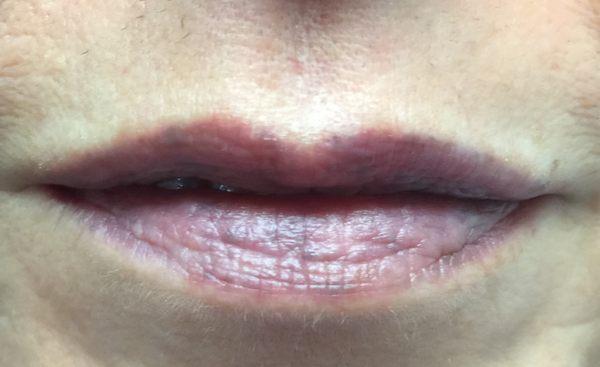 Before corrective lip procedure, scarring due to chemical burns