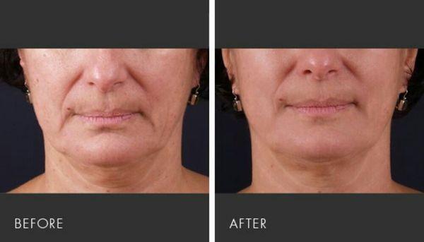 Affordable Facial with skin tightening using RF. Non surgical. No downtime