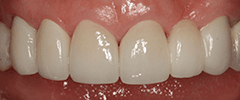 AFTER ALL CERAMIC CROWNS