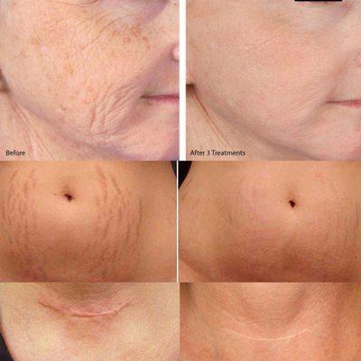 Microneedling improves: fine lines, wrinkles, dark/aging spots, hyperpigmentation, stretch marks, scars