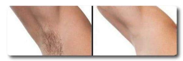 Underarm Before & After