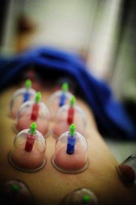 Cupping tech treatment