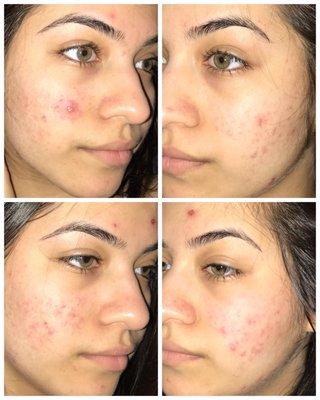 A couple of days difference after the chemical peel. The top is the before and the bottom is after.