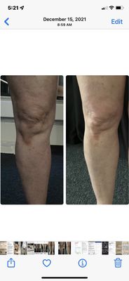 One session with our ULTRA THERAPY 
Look at the tightness and tone of the knee and the shape has already changed in 4 weeks