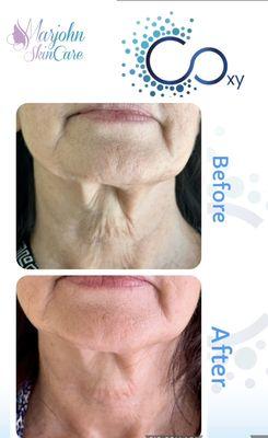 C.Oxy facial