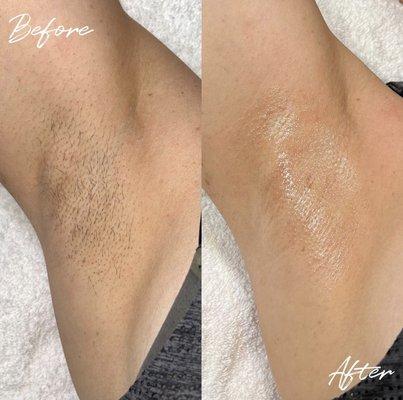 Underarm Sugar (Before + After)