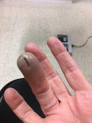 Infected finger after second surgery.