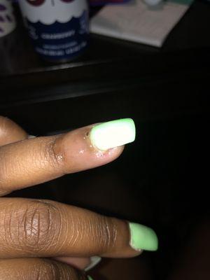 This is how swollen my nail got and I had to use antibiotics for it to heal.